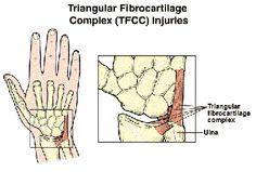 triangular-fibro-cartilage-tear